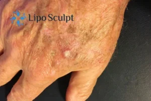 Best Actinic Keratoses Removal 2 Improve your wellbeing and health with Actinic Keratoses Avonmouth removal.treatment